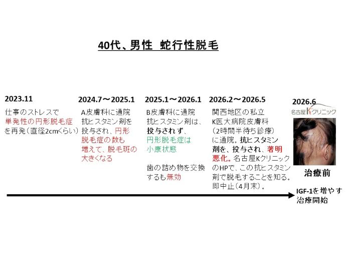 円形脱毛症　病院